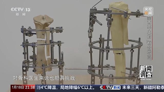 术后麻烦不断,禁而不止的“断骨增高” 有多坑?