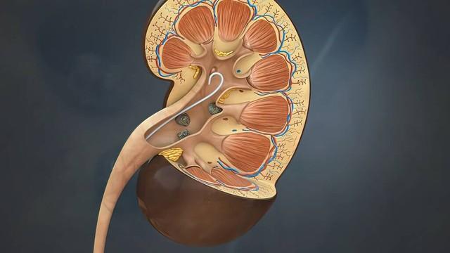 单位的美女同事突然喊肚子痛,去医院检查原来是肾结石!