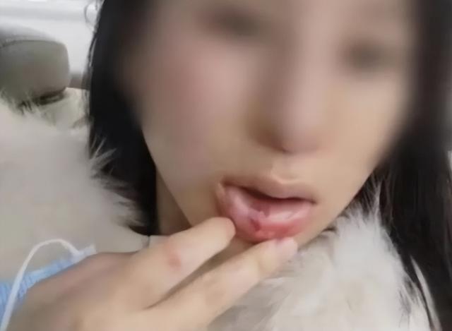 美女被丈夫家暴16次,肠子被打烂粪便污染腹腔,需终身挂粪袋