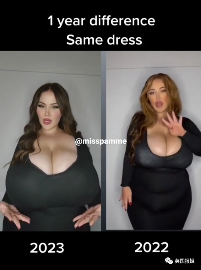 澳洲网红患上“巨乳症”,一年胸围暴涨6个罩杯!被压到喘不过气