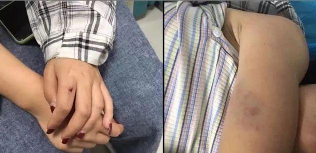 17岁女孩被室友扒衣围殴50分钟,打人者:我家有钱打死你怎么样?