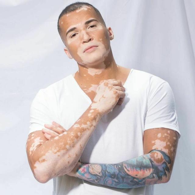 他大胆露出全身的白癜风，拍出的照片让34万人点赞