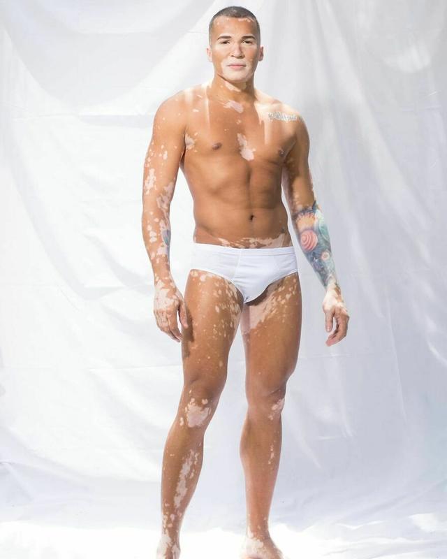 他大胆露出全身的白癜风，拍出的照片让34万人点赞