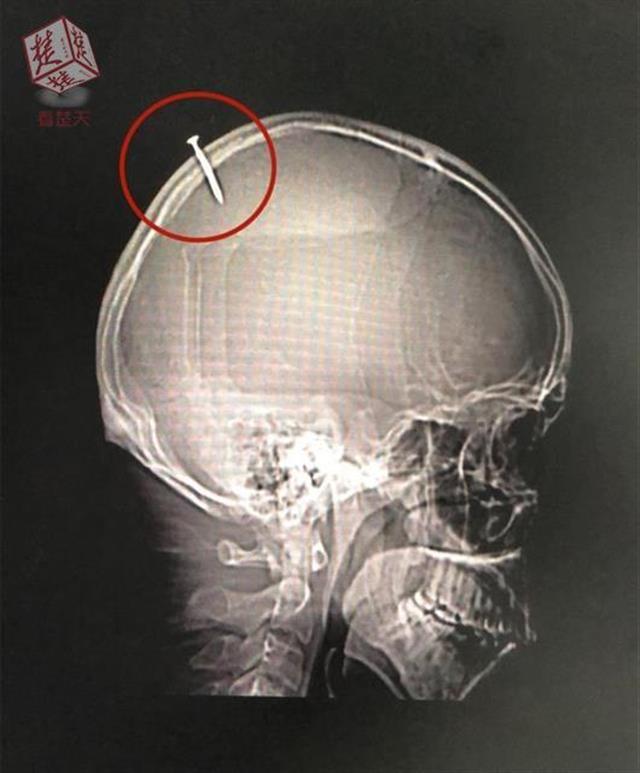 男子吵架情绪失控，竟将铁钉砸进自己脑袋