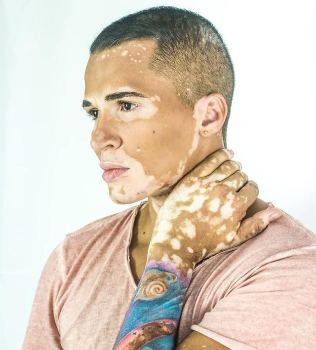 他大胆露出全身的白癜风，拍出的照片让34万人点赞