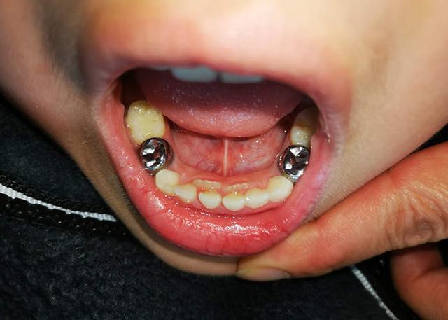 比电影还恐怖!6岁儿子突然长出双排牙齿,家长惊慌:拔还是不拔?