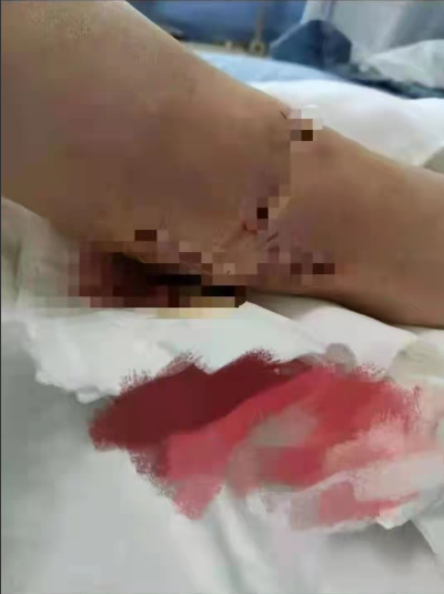 四川一“楼长”学姐查零食,13岁女生被罚150个下蹲,致终身残疾