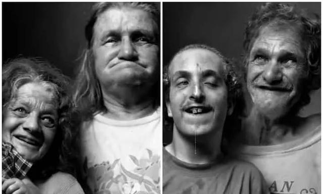 美国家族乱伦三代：近亲结合导致后代残障，无法说话只能犬吠