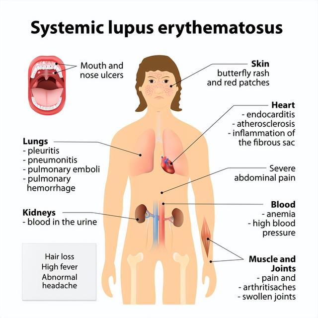 著名女歌手患罕见绝症后自杀！浑身痛到崩溃，赛琳娜MJ也得过
