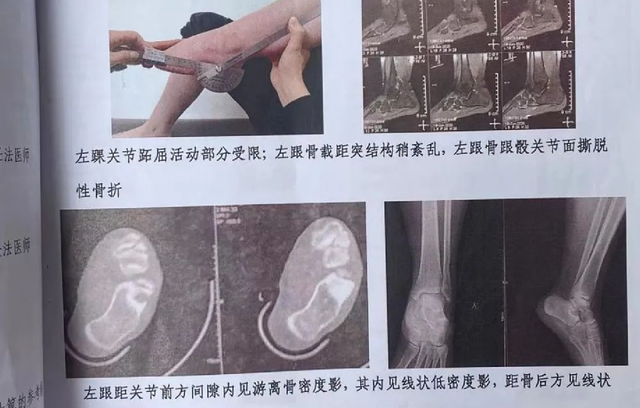 四川一“楼长”学姐查零食,13岁女生被罚150个下蹲,致终身残疾