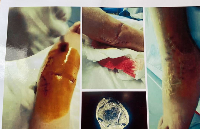 四川一“楼长”学姐查零食,13岁女生被罚150个下蹲,致终身残疾