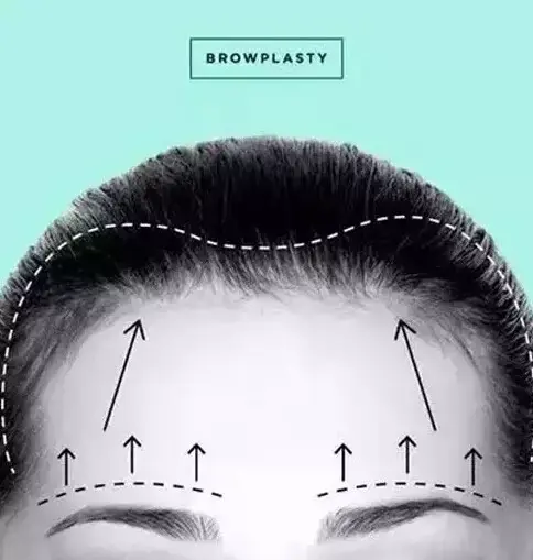 一秒看懂6种常见整形美容项目