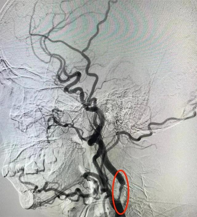 急！7旬老人突发脑梗死，颈动脉支架置入术撑起狭窄“一线天”