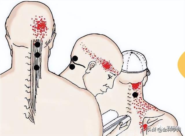 枕大神经体表定位 & 枕大神经痛的预防