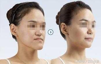 以下4种牙齿畸形可通过矫正来改变脸型，整牙相当于整容，靠谱！