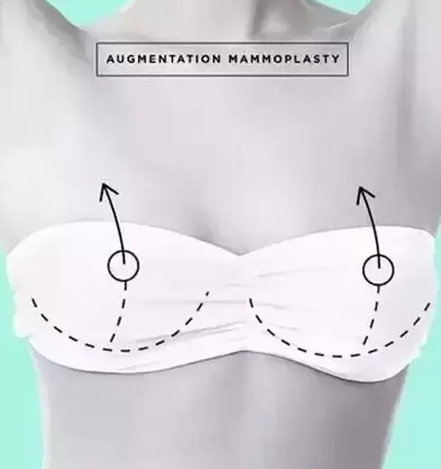 一秒看懂6种常见整形美容项目