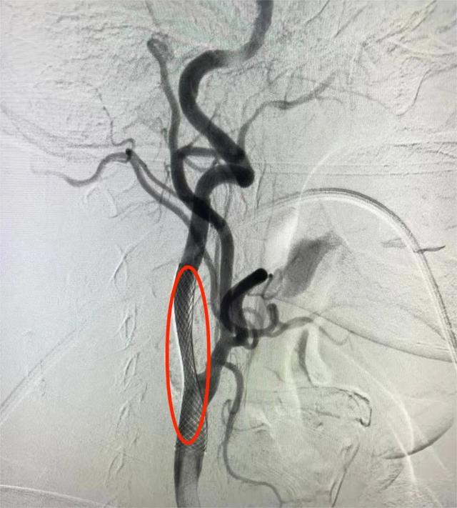 急！7旬老人突发脑梗死，颈动脉支架置入术撑起狭窄“一线天”