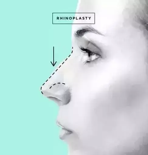 整形整容(一秒看懂6种常见整形美容项目)