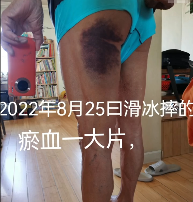 86岁王德顺滑冰摔倒！腿部大片淤血太渗人，不去医院坚持自我愈合