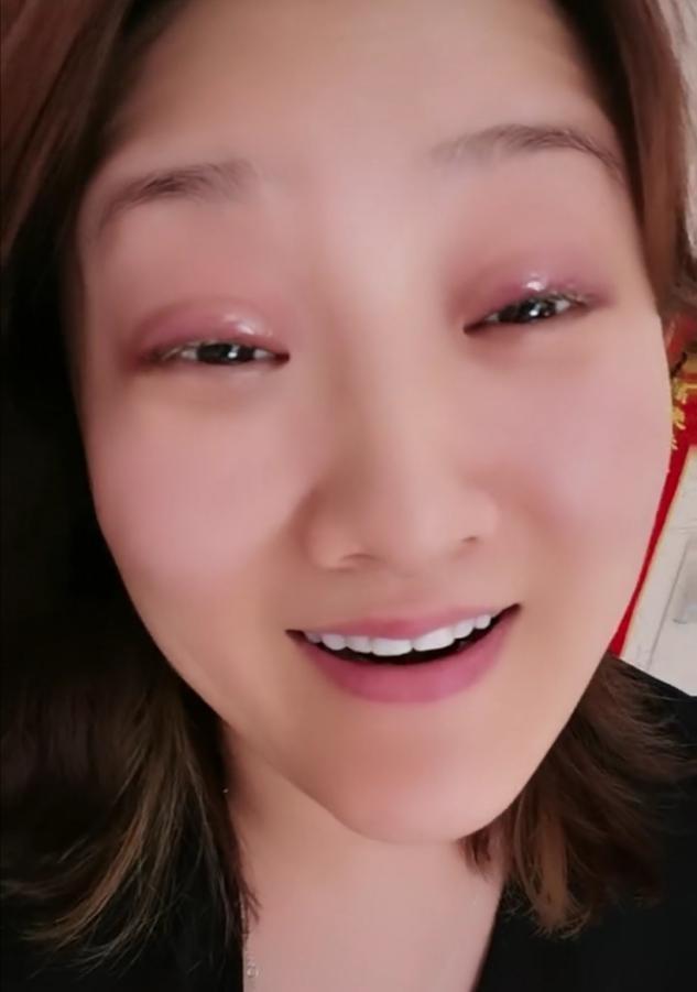 乡爱王云称整容失败，晒近况眼皮红肿超显眼，哭笑不得疑疼痛难忍