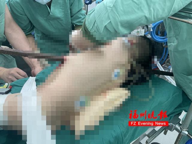 心疼！福建6岁男孩，身体被钢筋贯穿！医生这样救回来……
