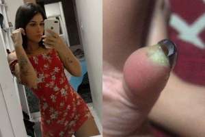 美女受伤(巴西妹子做美甲后拇指肿胀疼痛难忍，再去医院惨被截掉指尖)