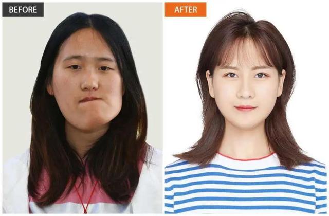 “歪脸女孩”治愈出院，她还做了一个决定