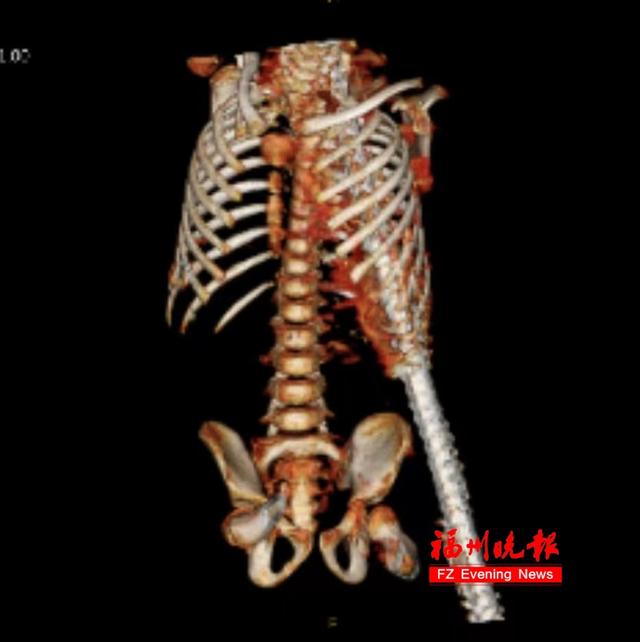 心疼！福建6岁男孩，身体被钢筋贯穿！医生这样救回来……