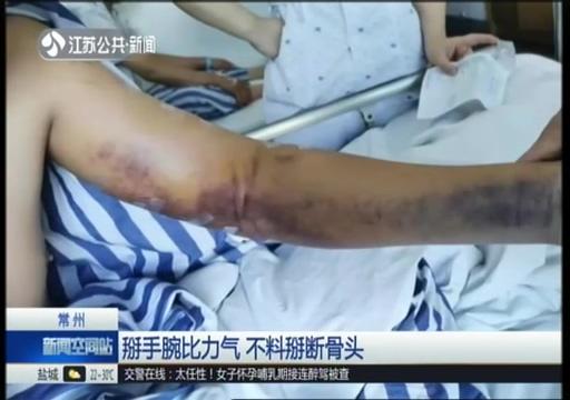 掰手腕需谨慎！大学生和朋友比力气，“吧嗒”的一声，粉碎性骨折