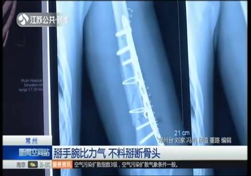 掰手腕需谨慎！大学生和朋友比力气，“吧嗒”的一声，粉碎性骨折