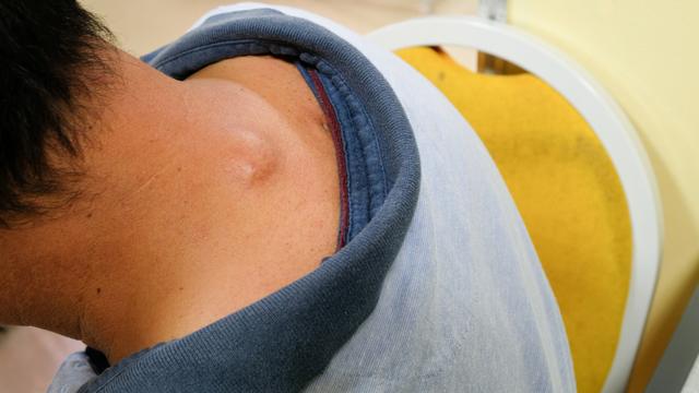 辟谣:后脑勺一个软软的肉疙瘩,不痛不痒,是肿瘤?看医生怎么说