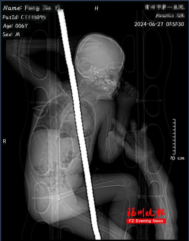 心疼！福建6岁男孩，身体被钢筋贯穿！医生这样救回来……