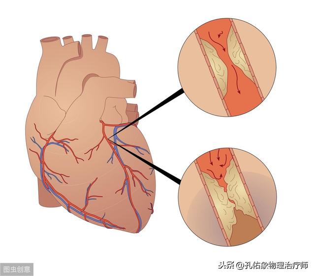 前胸贴后背的疼痛，不一定是心绞痛，建议收藏