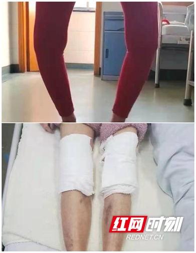疼痛20余年 当地”闻名”的罗圈腿竟变直了……