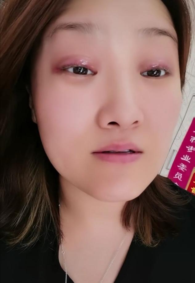 乡爱王云称整容失败，晒近况眼皮红肿超显眼，哭笑不得疑疼痛难忍