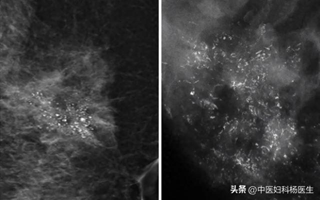 女子按摩院按摩乳房，一查竟是癌！医生说按摩要注意这几件事！