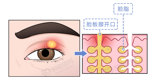 长了麦粒肿，怎么治疗好得快？一定要开刀吗？这几件事要记住