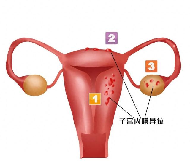 下个月就要结婚，28岁姑娘却将失去子宫……身体出现这些情况，要警惕！