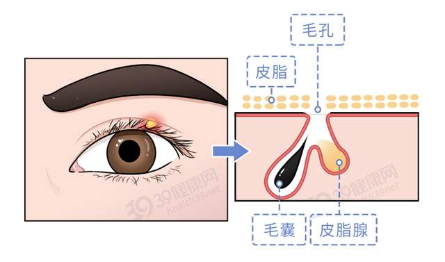 长了麦粒肿，怎么治疗好得快？一定要开刀吗？这几件事要记住