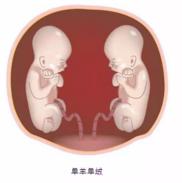 怀上双胞胎全家欣喜若狂，生产时看到两个男孩，医生摇头：活不长