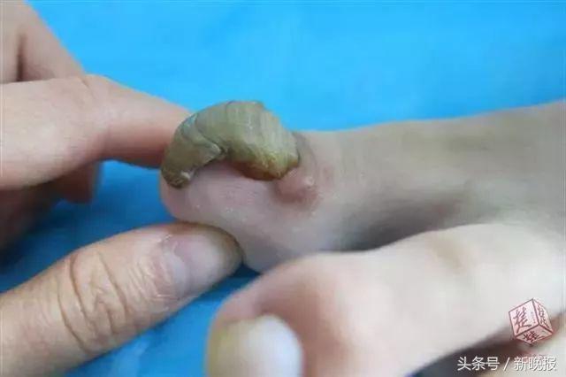 16岁少女6年没剪过趾甲！她脱掉袜子后，医生都惊呆了……