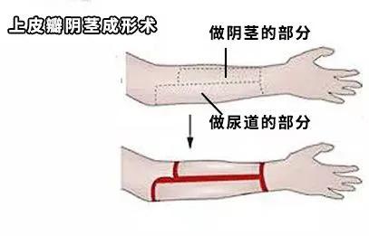 揭秘变性手术全过程：一个男人想变成女人，到底有多难？