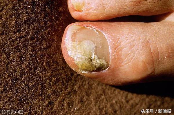 16岁少女6年没剪过趾甲！她脱掉袜子后，医生都惊呆了……