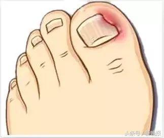 16岁少女6年没剪过趾甲！她脱掉袜子后，医生都惊呆了……