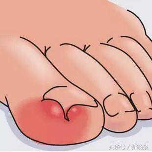 16岁少女6年没剪过趾甲！她脱掉袜子后，医生都惊呆了……