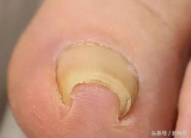 16岁少女6年没剪过趾甲！她脱掉袜子后，医生都惊呆了……
