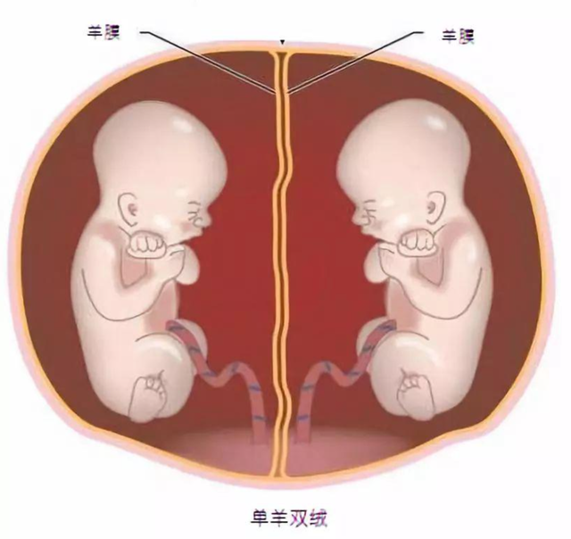 怀上双胞胎全家欣喜若狂，生产时看到两个男孩，医生摇头：活不长
