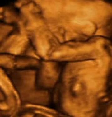 子宫里：双胞胎、三胞胎和四胞胎究竟什么样？八图带你一次看清楚