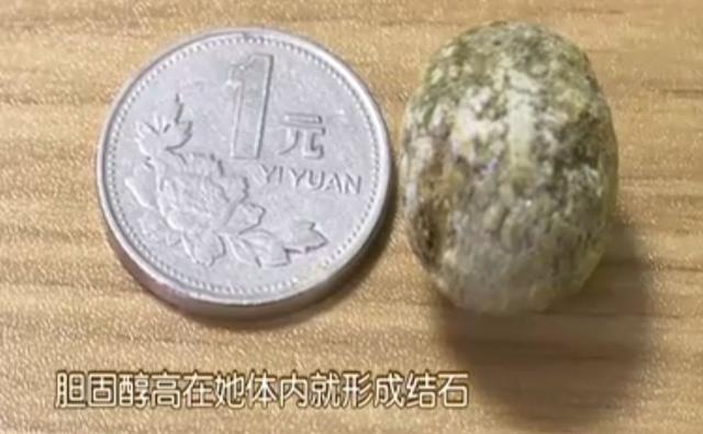 美女狂吃内脏结果悲剧了:体内塞满“话梅”被送医开刀