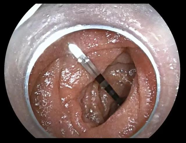 万万没想到！滑进喉咙消失了？男子吓懵：医生没敢告诉我……